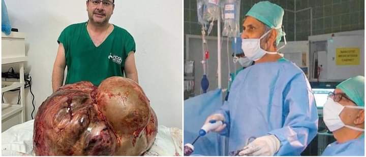 بوزن 45 كيلوغراما..إزالة أكبر ورم من جسم امرأة في اللبرازيل