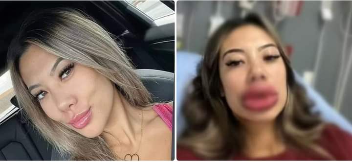 أرادت شفاه جميلة.. فتاة أمريكية أصبحت بشفاه مرعبة بسبب حقنة “فيلر” أثناء عملية تجميل