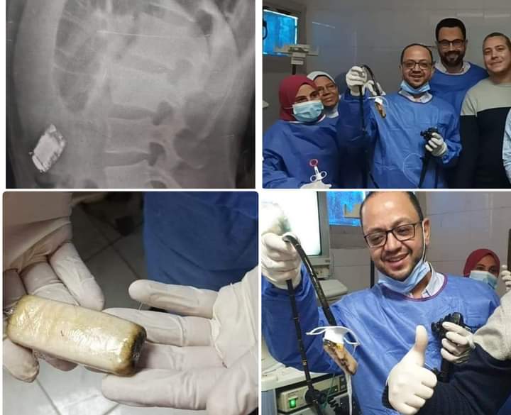 أطباء يستخرجون “موبايل” من بطن شاب في مصر