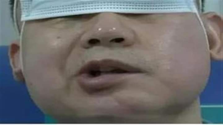 صيني يصاب بشلل في وجهه بعد متابعة مباريات المونديال لأسبوع كامل دون نوم