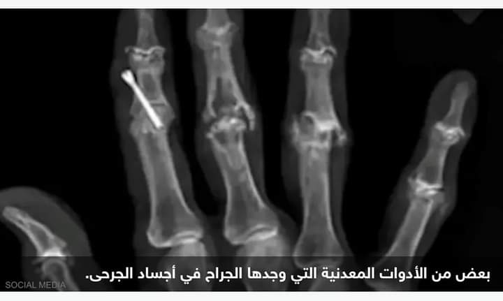 جراح يستعرض أشياء غريبة استخرجها من أجساد مصابين