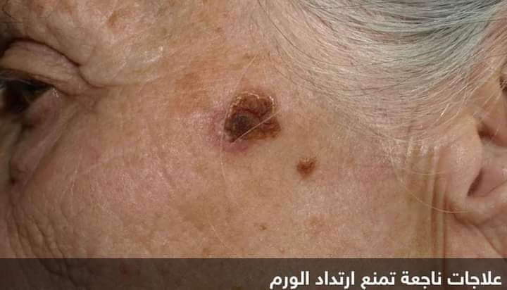 علماء يطورون نهجاً جديداً يمنع ارتداد “المرض الفتاك”