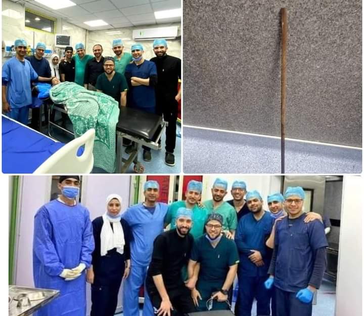 فريق طبي ينجح في استخراج “سيخ حديدي” من بطن طفل في مصر