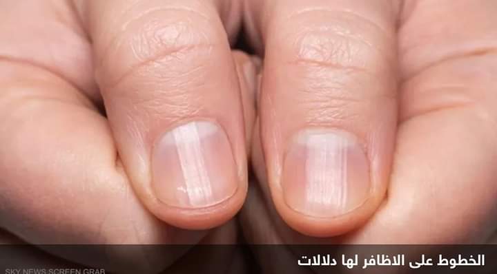 الخطوط على أظافرك.. “أسرار صحية” مرتبطة بالعمر