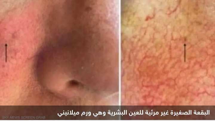 بقياس 0.65 ملم.. اكتشاف أصغر سرطان جلدي على الإطلاق