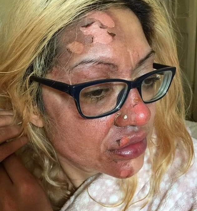 بسبب تحدي “تيك توك” ..بيض مسلوق يتسبب في حروق من الدرجة الثانية