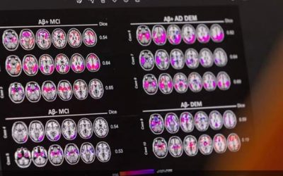 ضوء أخضر وموافقة نهائية على أول دواء يبطئ تطور الزهايمر