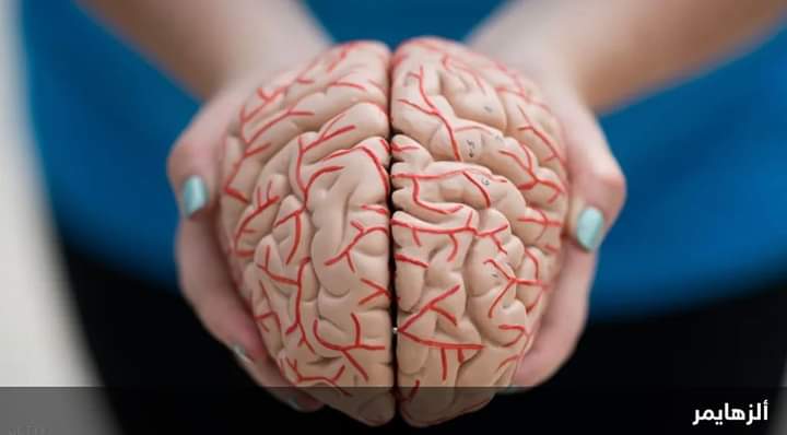 عقار من أكيومن لعلاج ألزهايمر يجتاز اختبارا أوليا للسلامة