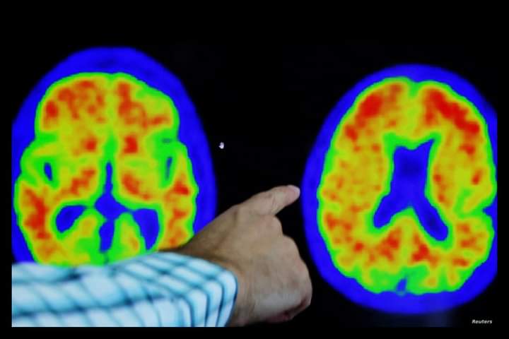 دراسة: مخاطر الخرف ترتبط بخلل بروتينات الدم في منتصف العمر