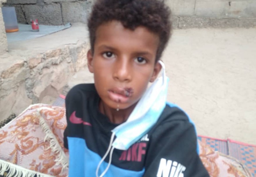 أبين :بدعم من التنسيقي الاعلى.. جمعية المرأه حصن عطية تقدم مساعدات للطفل الذي تعرض لعضة كلب في المنطقة