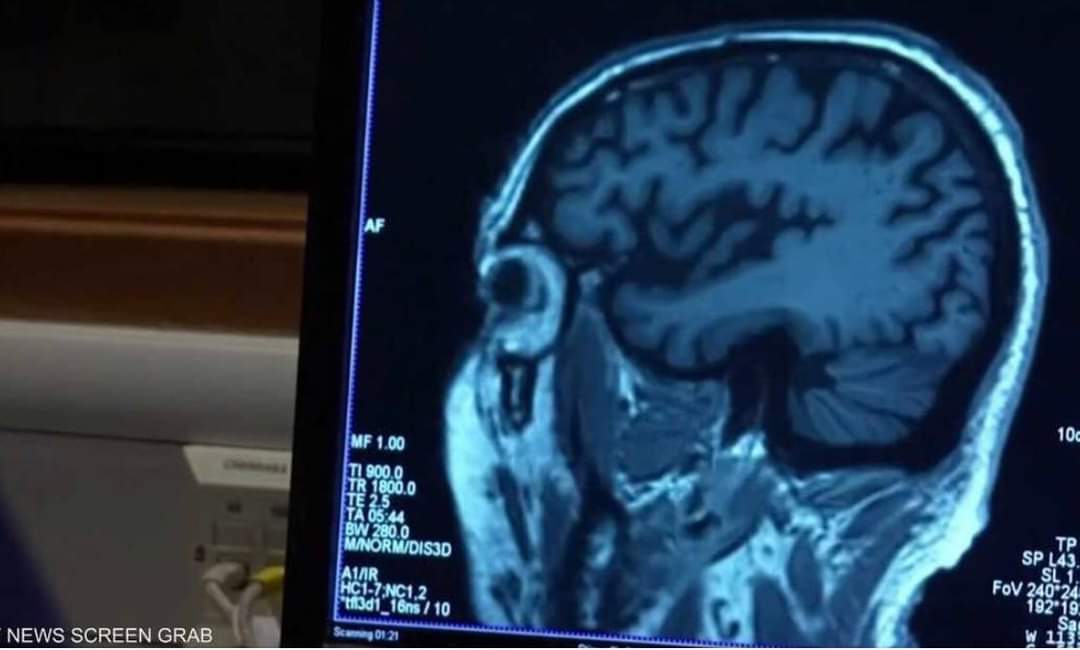 “لم يفت الأوان بعد”.. دعوات عالمية للتخفيف من ألزهايمر