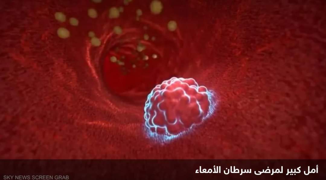 دراسة جديدة تمنح “أملا كبيرا” لمرضى سرطان الأمعاء