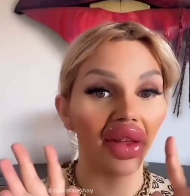 عملية تجميل فاشلة تشوه وجه فتاة بشكل غريب!