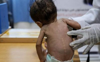 الأمم المتحدة: إصابة أكثر من 50 ألفا بالحصبة في اليمن هذا العام