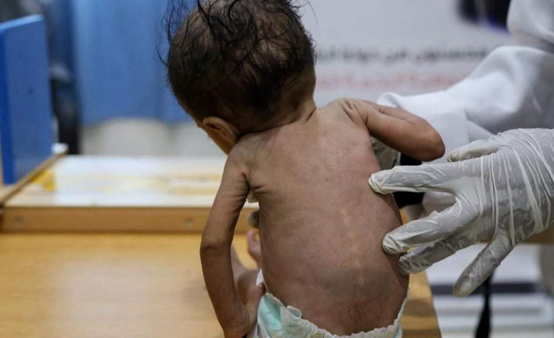 الأمم المتحدة: إصابة أكثر من 50 ألفا بالحصبة في اليمن هذا العام