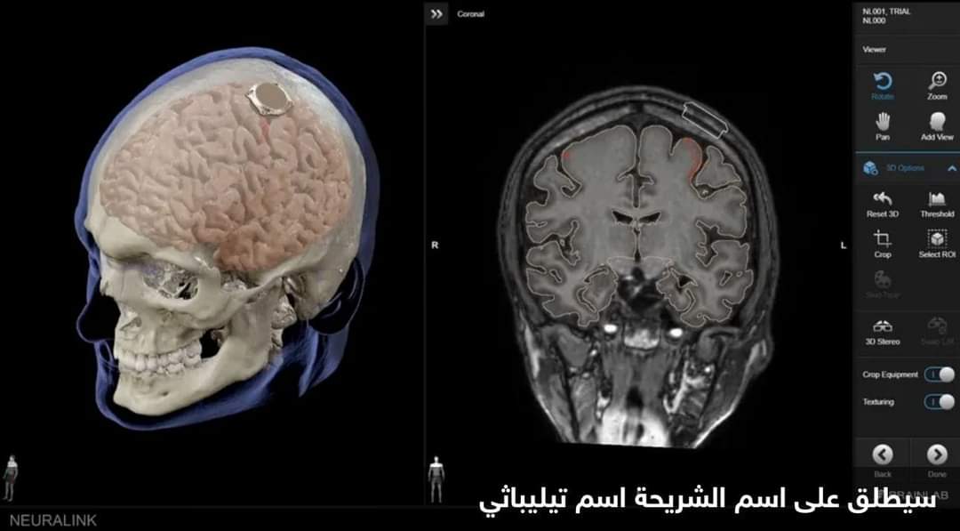 إيلون ماسك يعلن عن نجاح زرع شريحة دماغية في أول إنسان