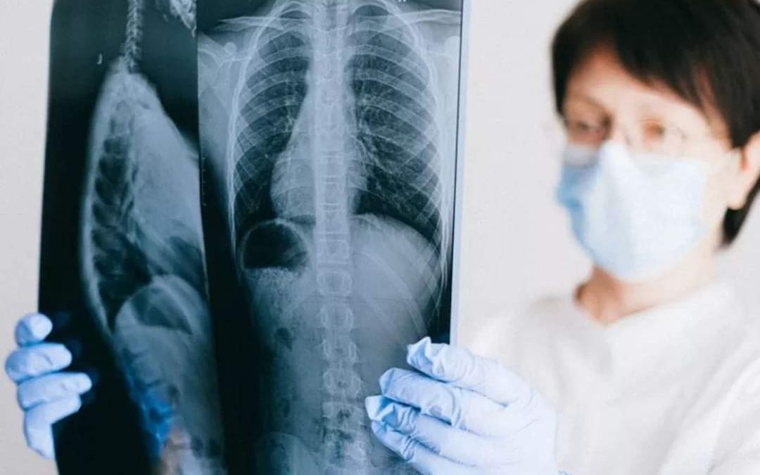 أعراض جلطة الرئة على مستوى عالٍ من الخطورة