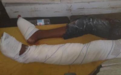 إصابة طفل بجروح بالغة إثر انفجار لغم حوثي غرب حيس