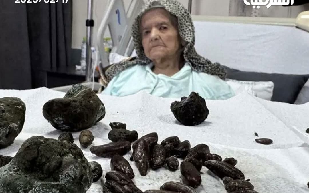 شاهد استخراج 63 نواة زيتون وتمر و5 كتل من الحصى الضخمة من مسنة تركية بعمر 92 عاماً