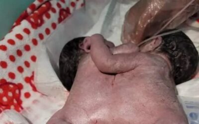 حالة نادرة.. ولادة طفلتين متلاصقتين بقلب واحد في ذمار اليمنية