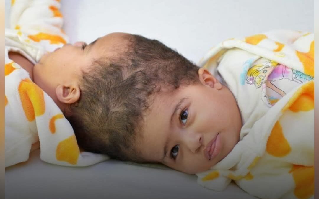 السعودية : نجاح عملية فصل التوأم السيامي الإرتيري