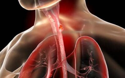 علماء يطورون كبسولة للكشف المبكر عن سرطان المريء