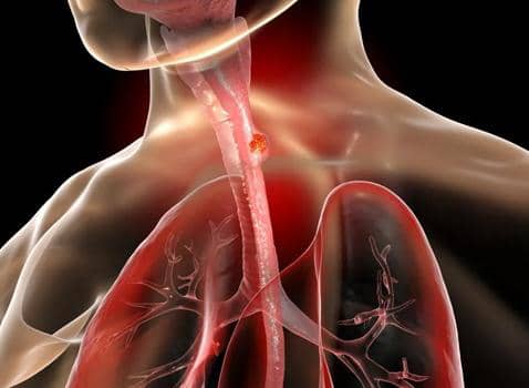 علماء يطورون كبسولة للكشف المبكر عن سرطان المريء