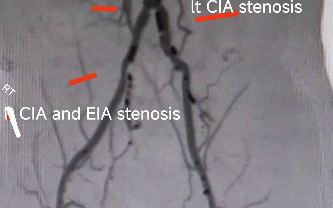 التدخل القسطري لمرضى السكر وأمراض القلب