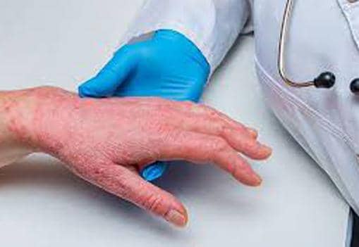 أول إصابة بسلالة “إمبوكس 1ب” في برلين