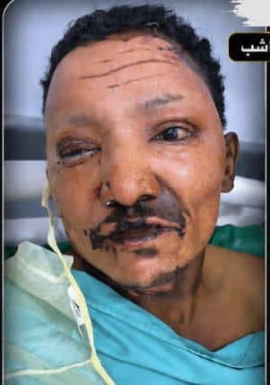 مناشدة عاجلة لإنصاف الجندي الجريح غسان أحمد قاسم الحوشبي.. مطالب بسرعة التدخل لعلاجه وصرف مستحقاته