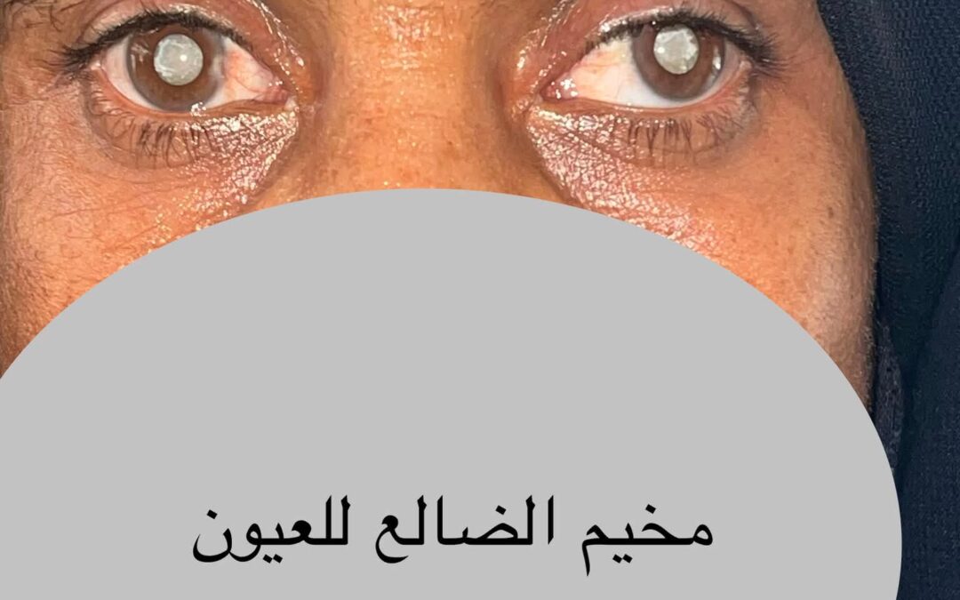 في مخيم الضالع.. أمٌّ تستعيد نظر عينيها لتبصر أبناءها بعد خمس سنوات من الظلام